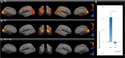 Sight restoration reverses blindness-induced cross-modal functional connectivity changes between the visual and somatosensory cortex at rest